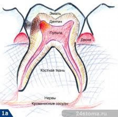 Лечение острого очагового пульпита. Клиника острого пульпита