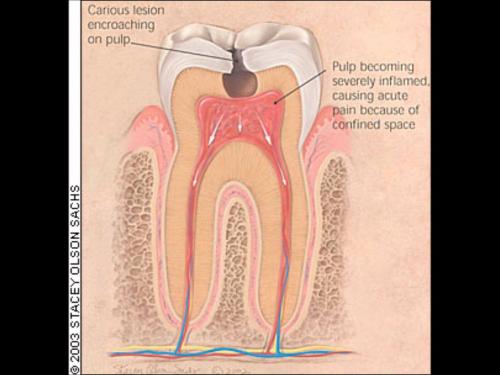 Лечение острого очагового пульпита. Клиника острого пульпита