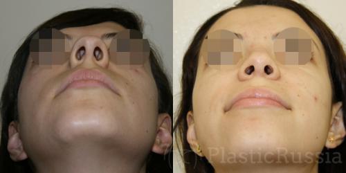 Форма носа у женщин. Идеальный профиль — идеальный нос: