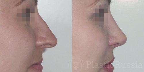 Форма носа у женщин. Идеальный профиль — идеальный нос: