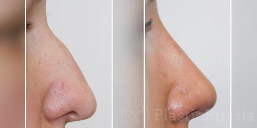 Форма носа у женщин. Идеальный профиль — идеальный нос: