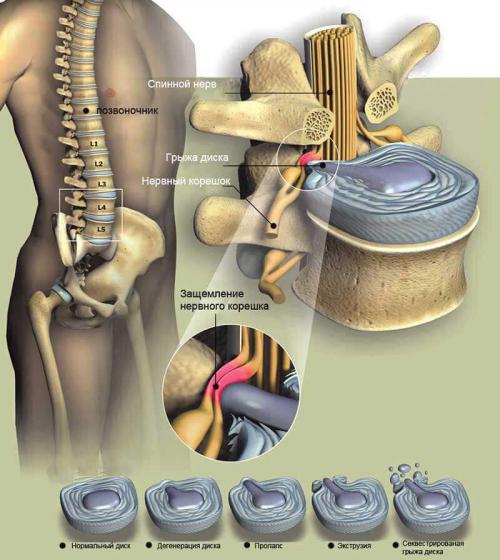 Что нельзя делать при грыже l5-s1. Особенности