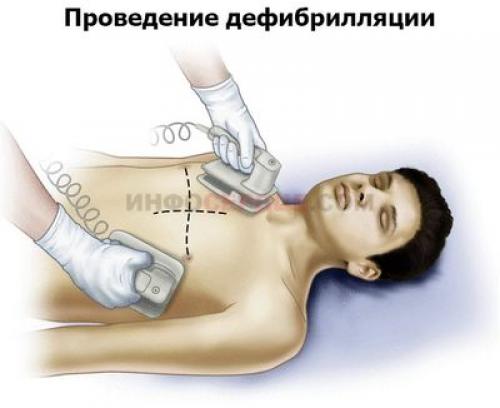 Как работает дефибриллятор: основные принципы работы 01 Как работает дефибриллятор: основные принципы работы 01