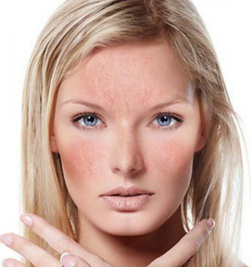 Венозная гиперемия: причины, виды, классификация, признаки, симптомы, лечение