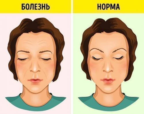 Болезнь внутренних органов по лицу. Зоны проекций - Лицо 07