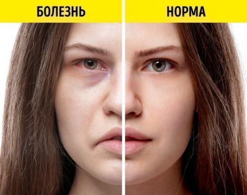 Болезнь внутренних органов по лицу. Зоны проекций - Лицо 11