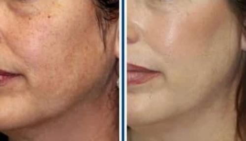 Отбеливающие домашние средства. Как отбелить кожу лица