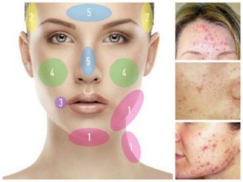Области на лице отвечающие за органы. За какие органы отвечают прыщи на лице?