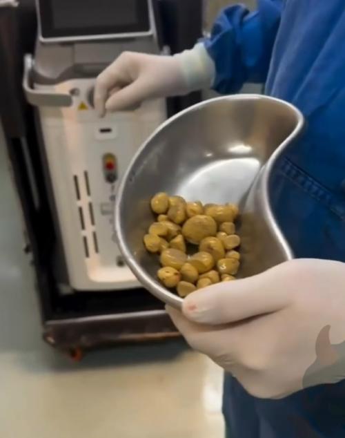 Мужик в Бразилии каждый день заливал в себя по 2-3 литра колы и накопил в себе не сахар, а камни. 01