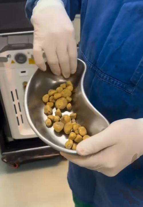 Мужик в Бразилии каждый день заливал в себя по 2-3 литра колы и накопил в себе не сахар, а камни.  