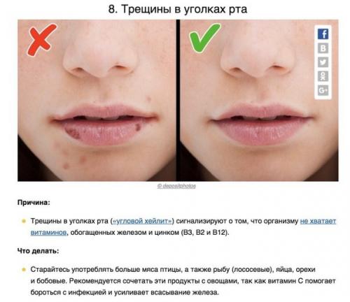 8 сигналов тела, которые помогают понять, каких витаминов не хватает вашему организму. 07