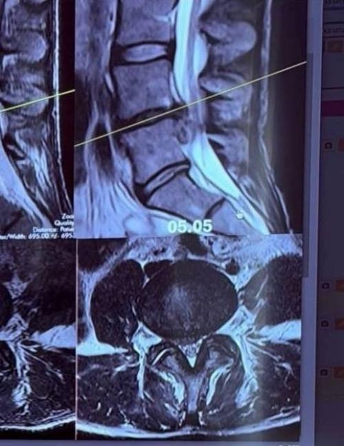 Попала в Инвалидную Коляску После Массажа Спины - 34-летняя супруга Александра цекало вышла на связь с неприятными новостями. 03