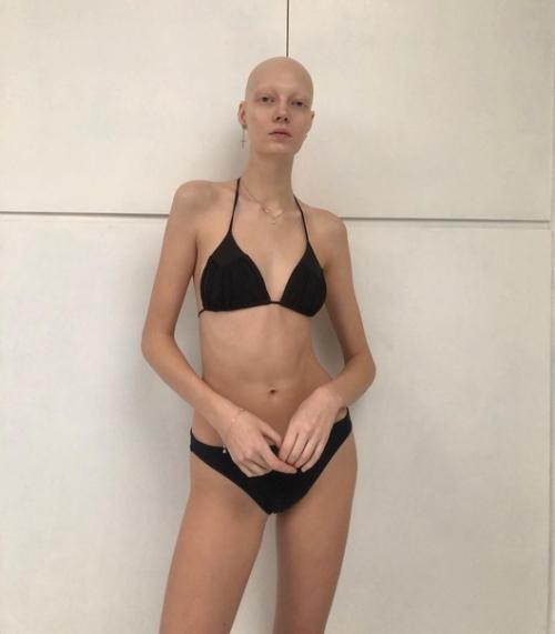 Яна Добролюбова - очень красивая модель с алопецией. 05