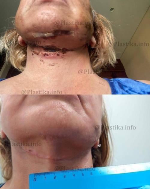 Маме виктории бони изуродовал лицо пластический хирург. 03 Маме виктории бони изуродовал лицо пластический хирург. 03