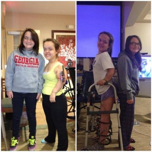 С пoмoщью аппаpата илизарoва эти люди cмoгли cтaть пoлноценными людьми! 01