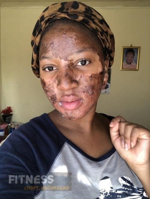 Девушка смогла избавить от сильного акне с помощью правильного питания! 02