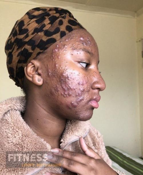 Девушка смогла избавить от сильного акне с помощью правильного питания! 01