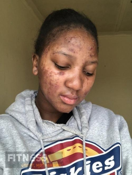 Девушка смогла избавить от сильного акне с помощью правильного питания! 03