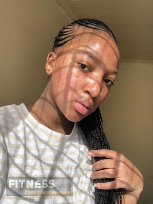 Девушка смогла избавить от сильного акне с помощью правильного питания! 06