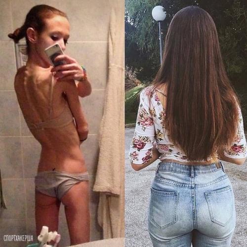 Я думаю, анорексия - это такое же страшное заболевание как и ожирение. 03