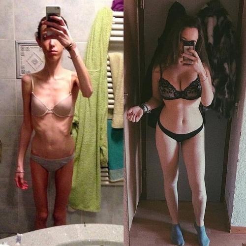 Я думаю, анорексия - это такое же страшное заболевание как и ожирение. 02