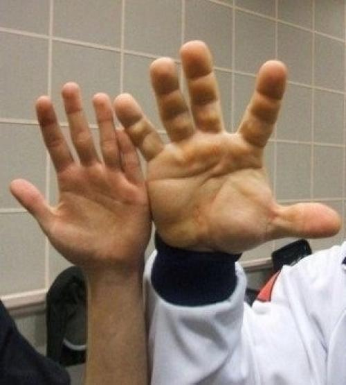 Вот так выглядят руки одного из сильнейших людей России и мира, Дениса цыпленкова. 02