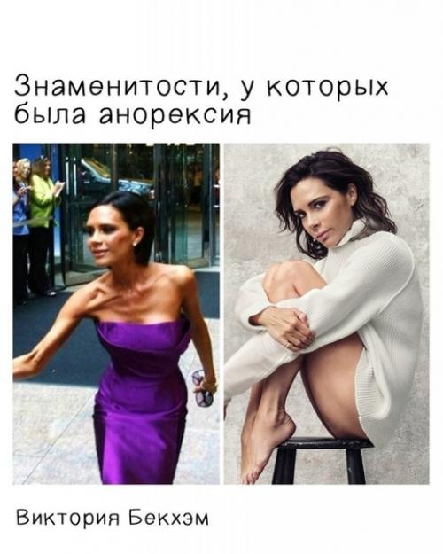 Знаменитости, у которых была анорексия. 01