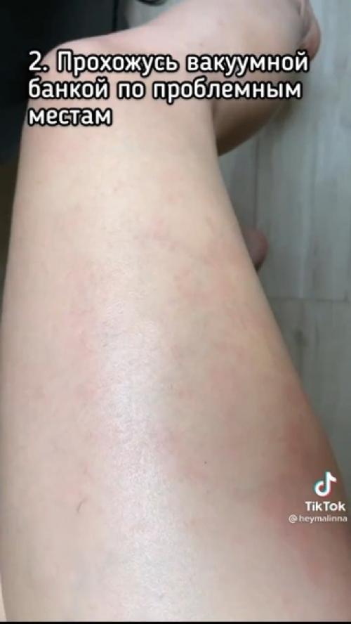 Антицеллюлитный массаж.  Ожидания и реальность. 03