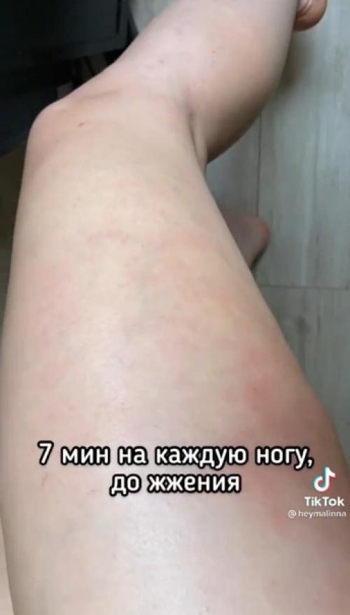 Антицеллюлитный массаж.  Ожидания и реальность. 02