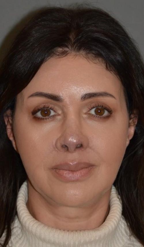 Страшно смотреть на фото до, но какая красота после: Алисе аршавиной заново воссоздали исчезнувший нос. 01