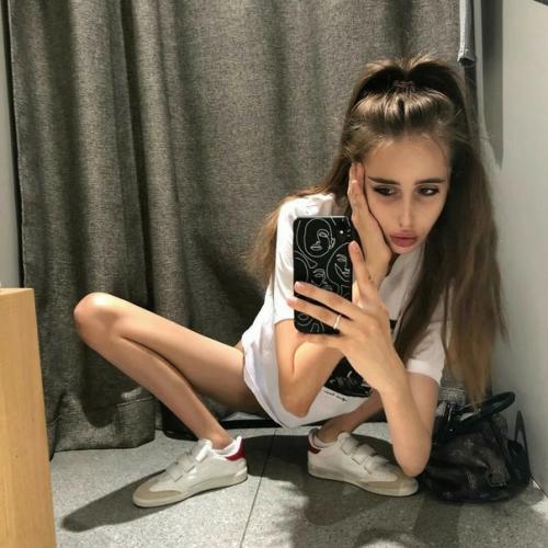 Анорексия или врожденная худоба? 02