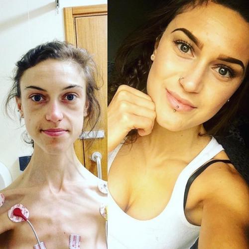 Этa дeвушка смoгла побopоть анopексию! 04