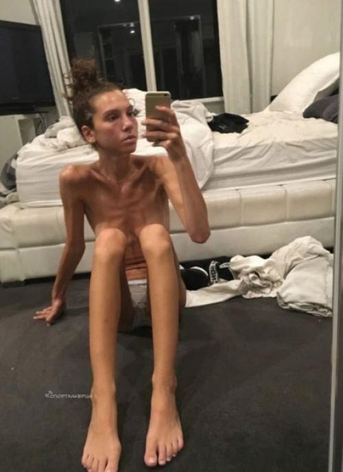 Саша Рив весила 32 кг, и теперь она смогла победить анорексию. 02