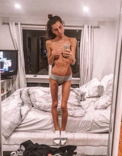 Саша Рив весила 32 кг, и теперь она смогла победить анорексию. 01