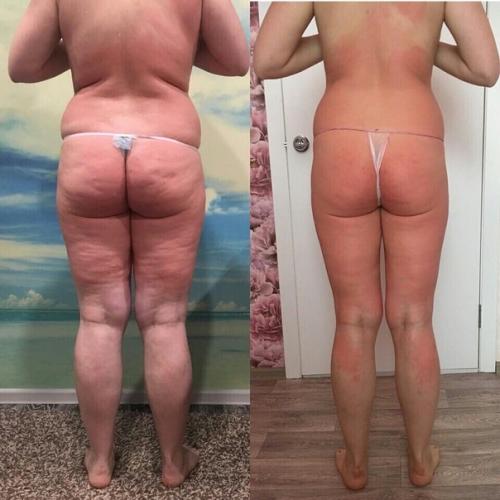 Аппаратный массаж коррекция фигуры, метро новочеркасская. 06