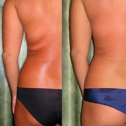 Аппаратный массаж коррекция фигуры, метро новочеркасская. 01