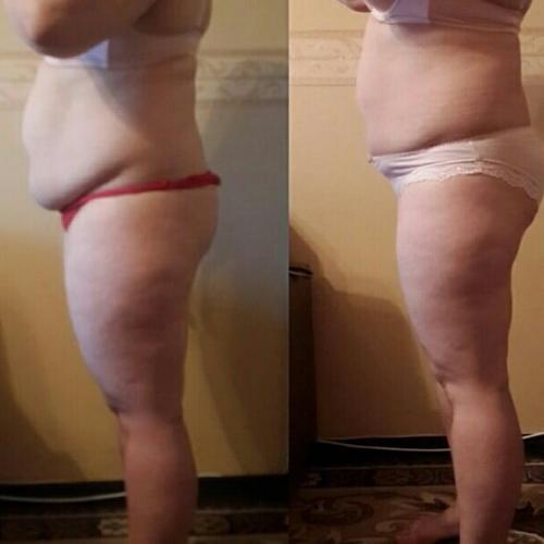 Аппаратный массаж коррекция фигуры, метро новочеркасская. 05