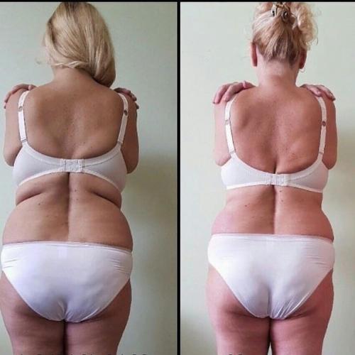 Аппаратный массаж коррекция фигуры, метро новочеркасская. 07