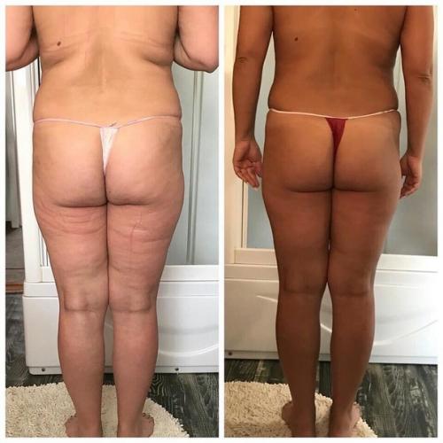 Аппаратный массаж коррекция фигуры, метро новочеркасская. 02