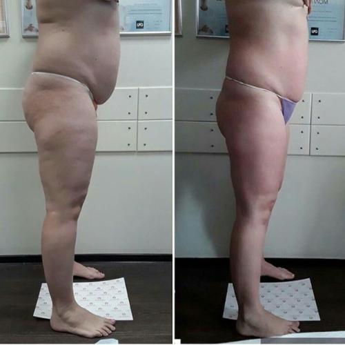 Аппаратный массаж коррекция фигуры, метро новочеркасская. 03