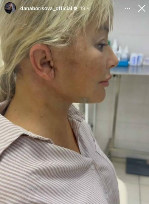 49-Летняя дана Борисова показала результаты очередной пластической операции. 01