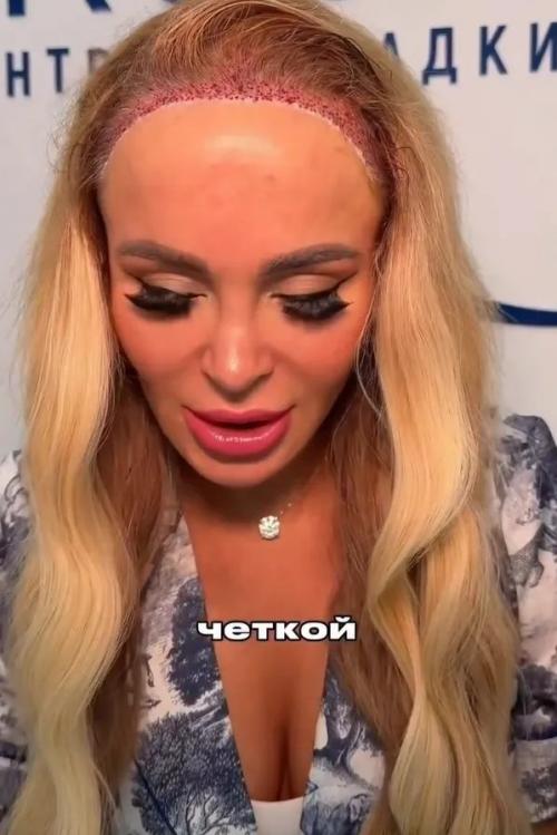 Я Комплексую Из-за Высокого лба и Залысин: Анна Калашникова призналась, что ей сделали пересадку волос. 02