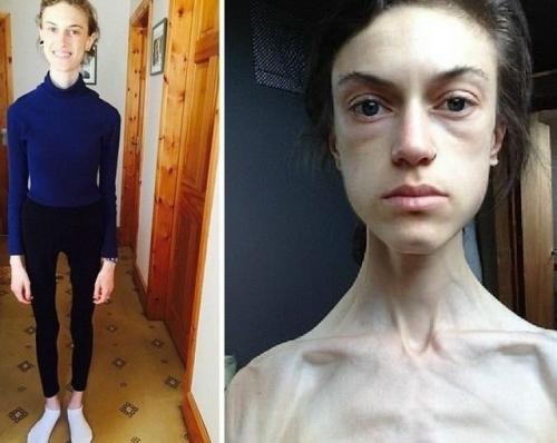 Путь эмел Льюис - это не просто история похудения и набора веса, это история возвращения к жизни. 01